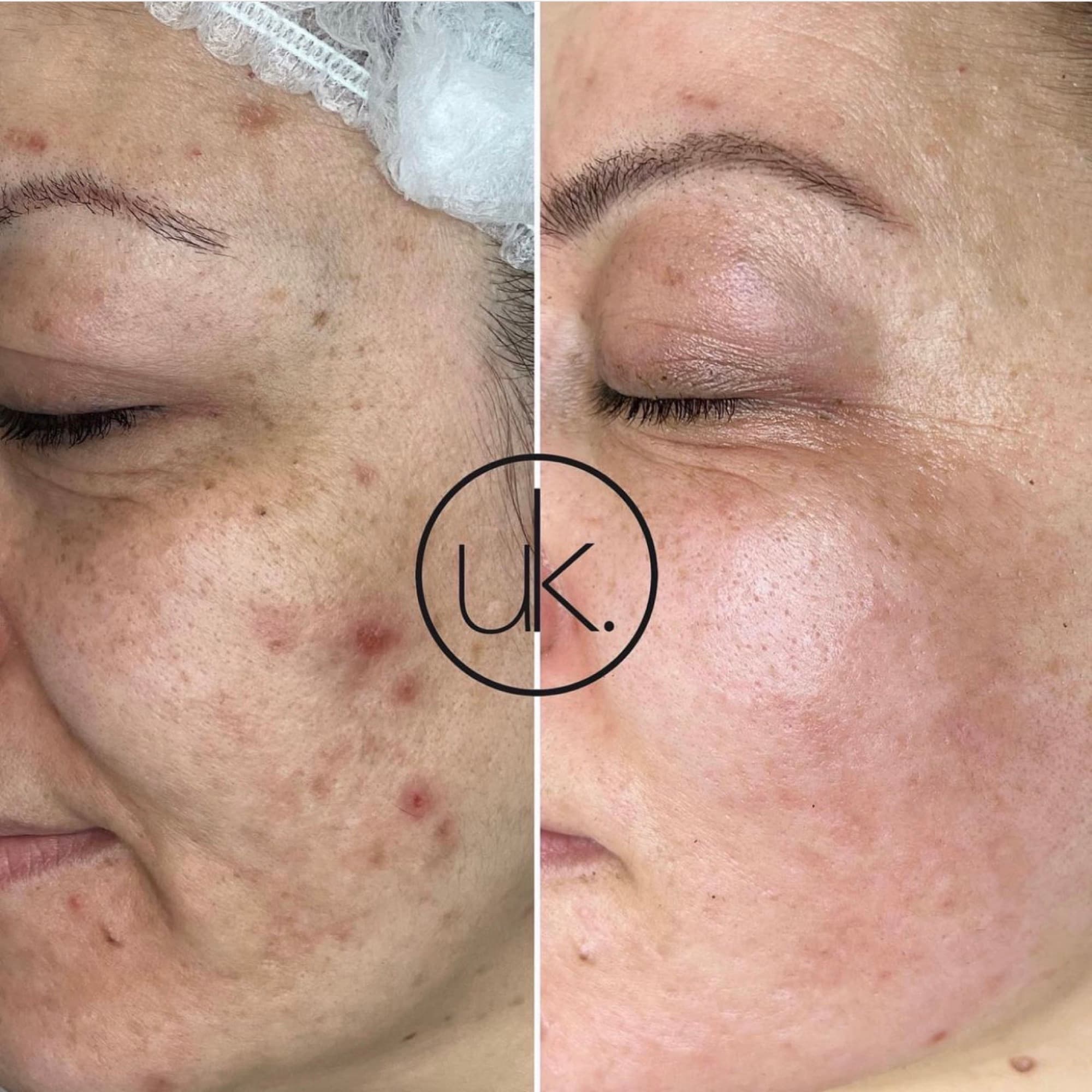 GreenPeel® in der uk Kosmetik Academy Velbert